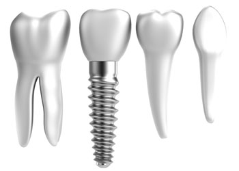 Dental Implants in Payson, AZ